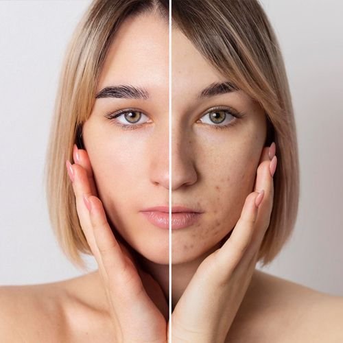 Freckles Removal